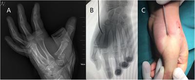 Open vs. closed reduction with pinning for displaced Rockwood and Wilkins' type C thumb metacarpal base fractures in children